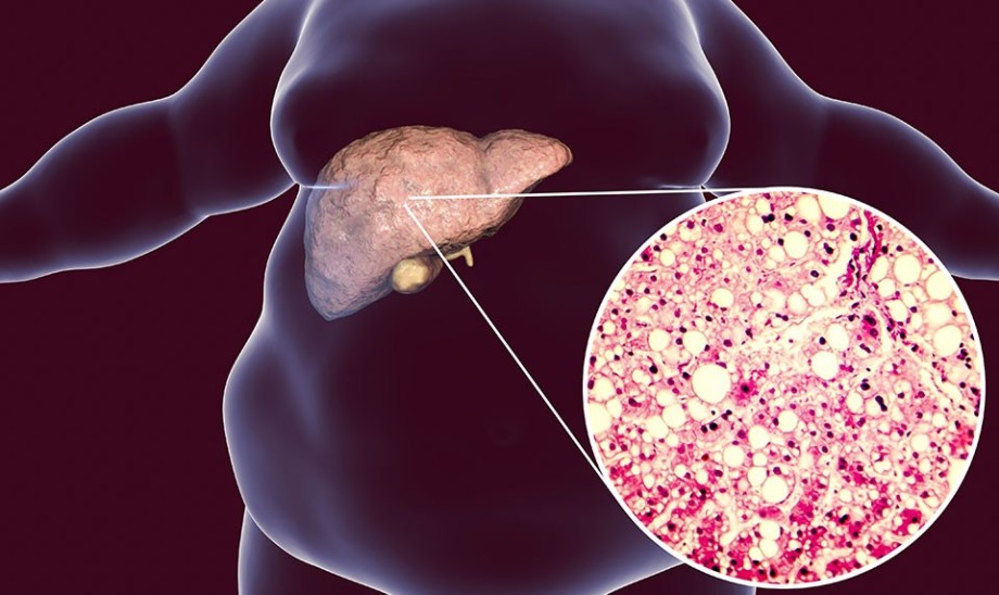 Niealkoholowe stłuszczenie wątroby