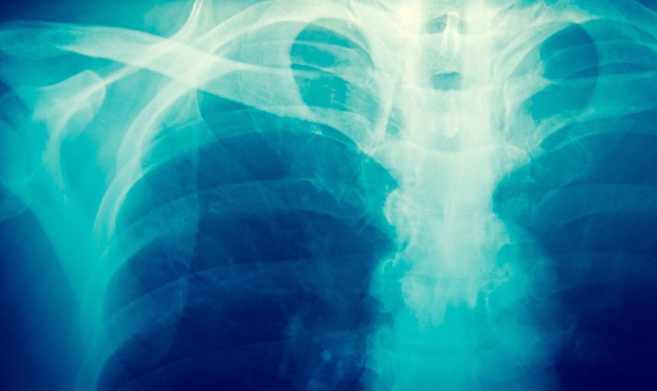 Często spotykana choroba kości