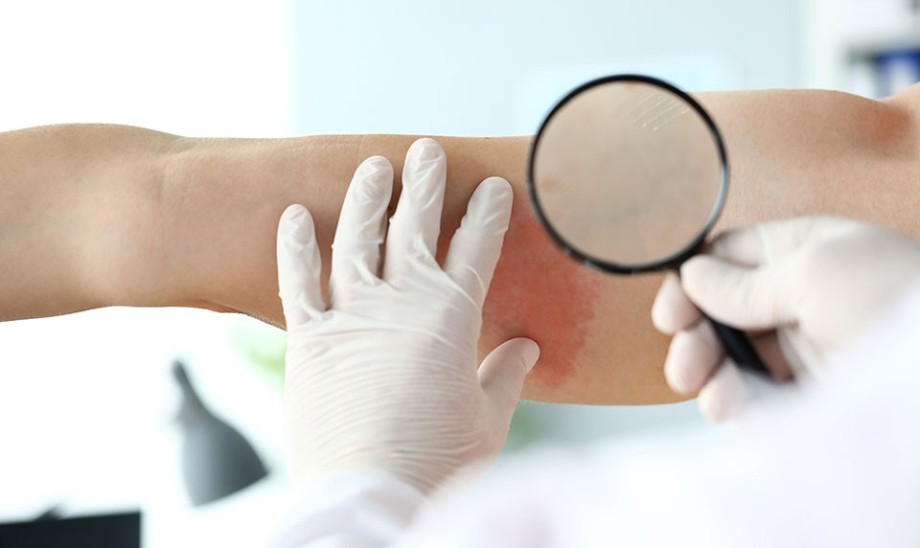 Objawy chorób wewnętrznych na skórze