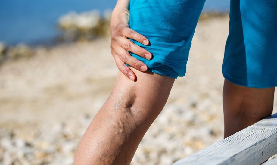 Naturalne sposoby na żylaki