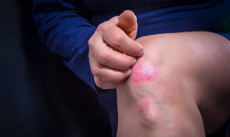 Uciążliwa choroba skóry oraz stawów