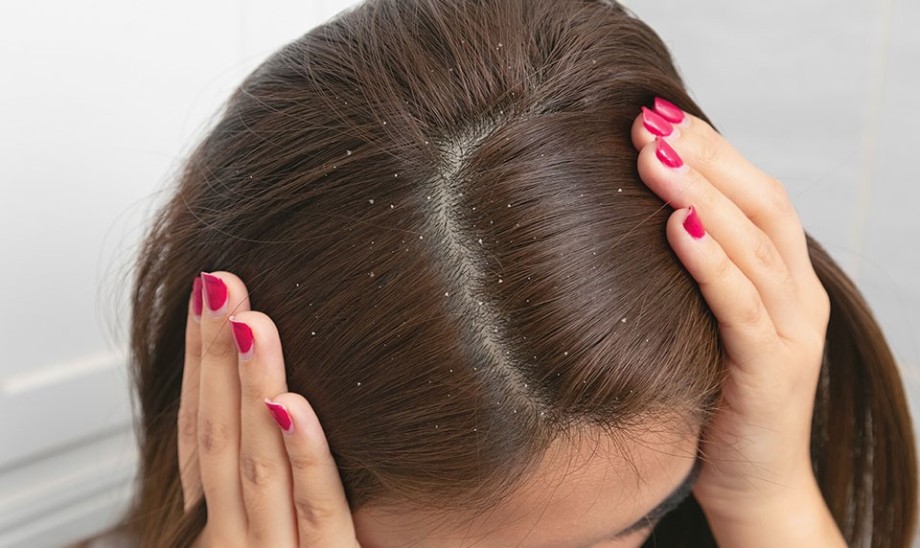 Łupież – problem nie tylko estetyczny