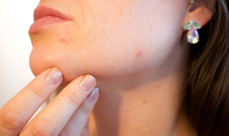Kłopotliwy trądzik u osób dorosłych