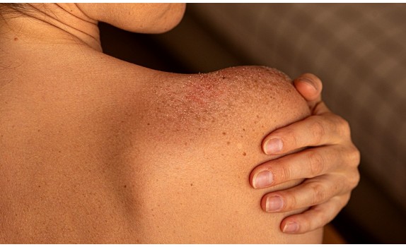 Co niszczy kolagen w organizmie? 7 czynników, na które musisz uważać!